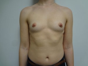 Manhattan Breast Augmentation Before 2